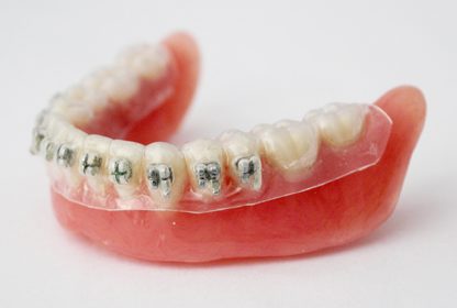 Chỉnh nha mắc cài gián tiếp