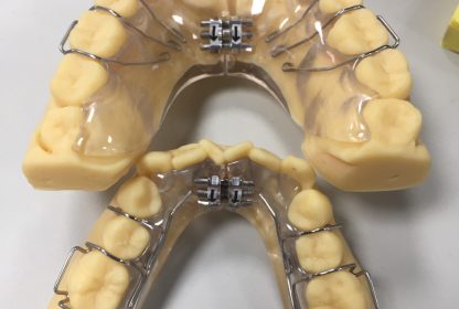 Các khí cụ chỉnh nha